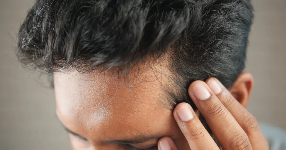A close-up of a receding hairline at the temple, the pattern behind the question is laser hair growth device worth it